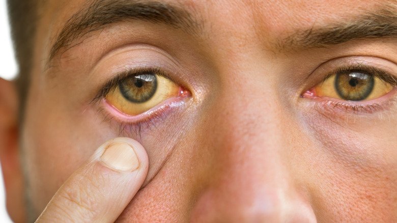 Jaundice Treatment